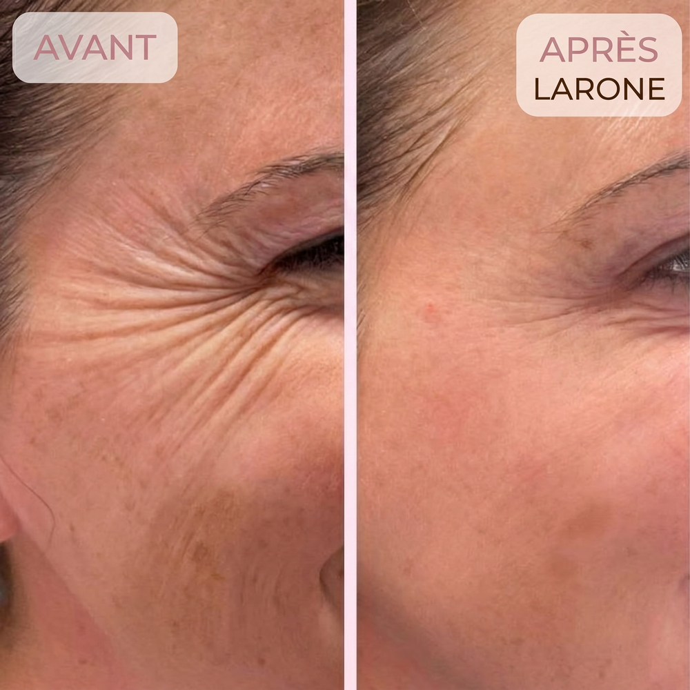 Vos pattes-d'oie disparaissent sans effet « refait »